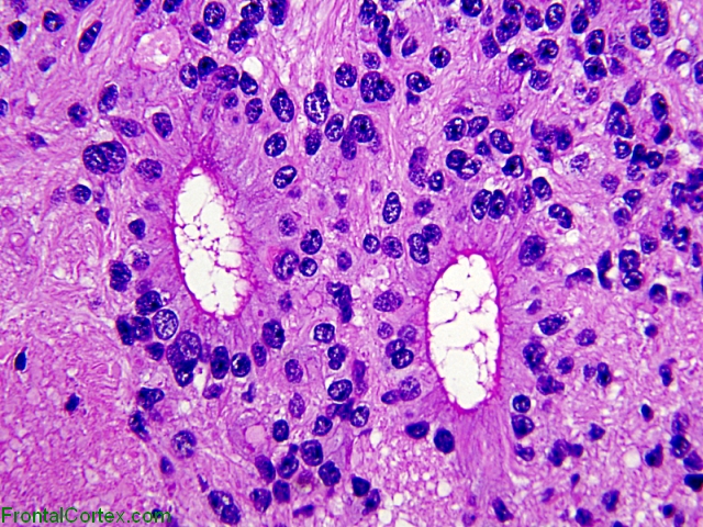 True ependymal rosettes x400